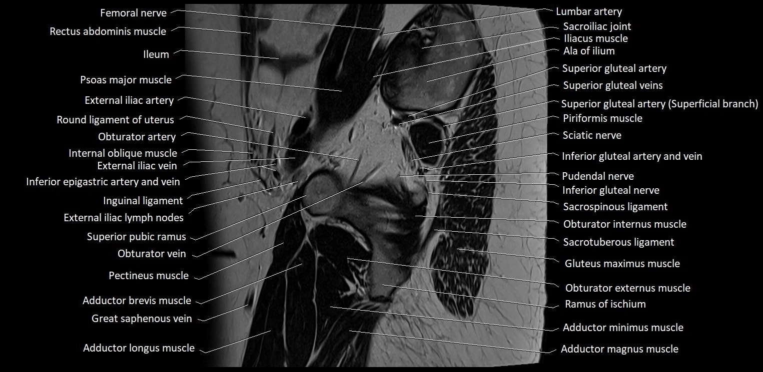 Sagittal cross sectional anatomy of female pelvis (MRI 3T) image 5.webp